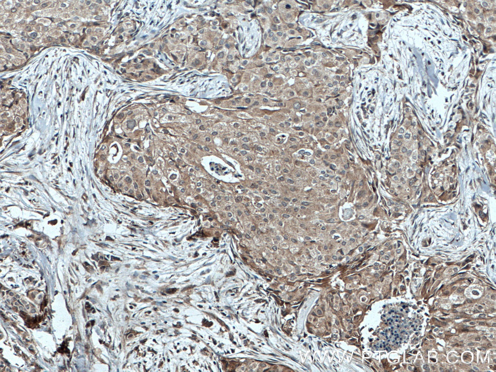 Immunohistochemistry (IHC) staining of human breast cancer tissue using TPM2 Polyclonal antibody (55443-1-AP)