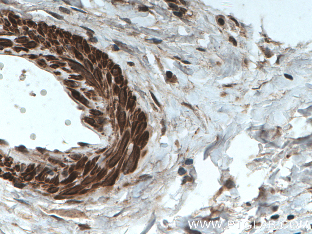 Immunohistochemistry (IHC) staining of human breast cancer tissue using TPM2 Polyclonal antibody (55443-1-AP)