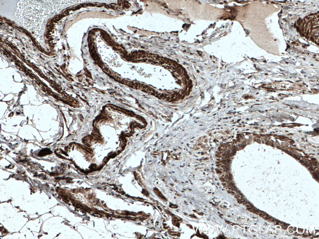 Immunohistochemistry (IHC) staining of human breast cancer tissue using TPM2 Polyclonal antibody (55443-1-AP)