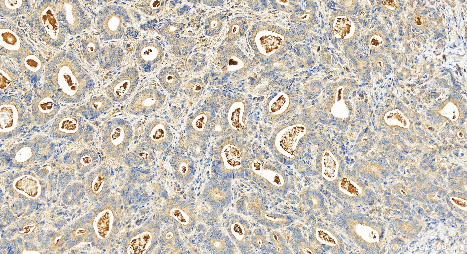 Immunohistochemistry (IHC) staining of human stomach cancer tissue using TPPP3 Polyclonal antibody (15057-1-AP)