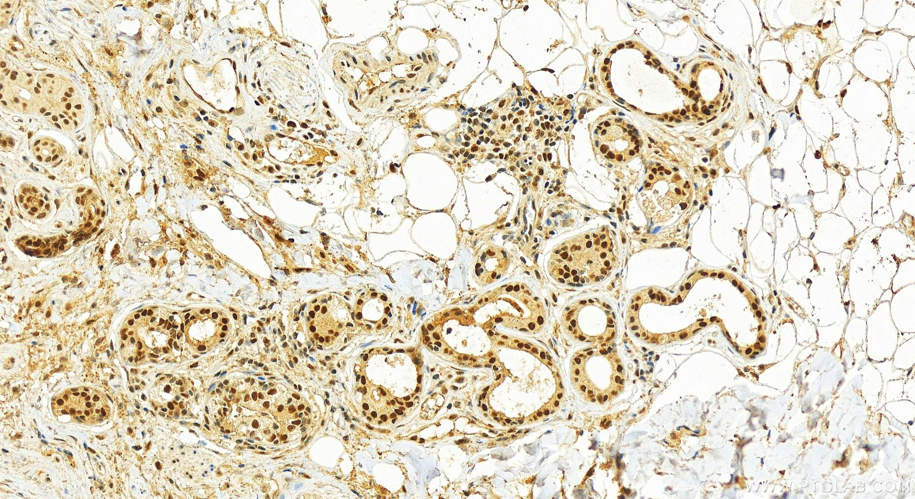 Immunohistochemistry (IHC) staining of human skin cancer tissue using TPRKB Monoclonal antibody (66402-1-Ig)