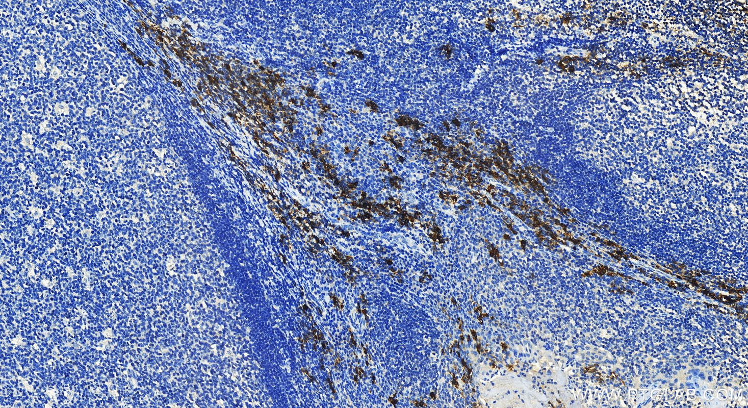 Immunohistochemistry (IHC) staining of human tonsillitis tissue using TPSAB1 Polyclonal antibody (13343-1-AP)