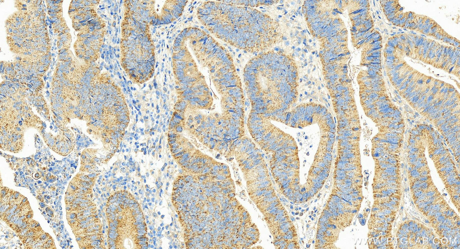 Immunohistochemistry (IHC) staining of human colon cancer tissue using TPT1 Polyclonal antibody (10824-1-AP)