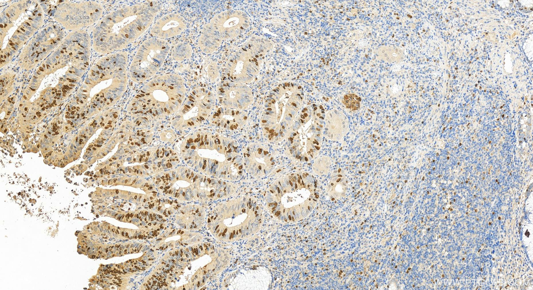 Immunohistochemistry (IHC) staining of human colon cancer tissue using TPX2 Polyclonal antibody (11741-1-AP)