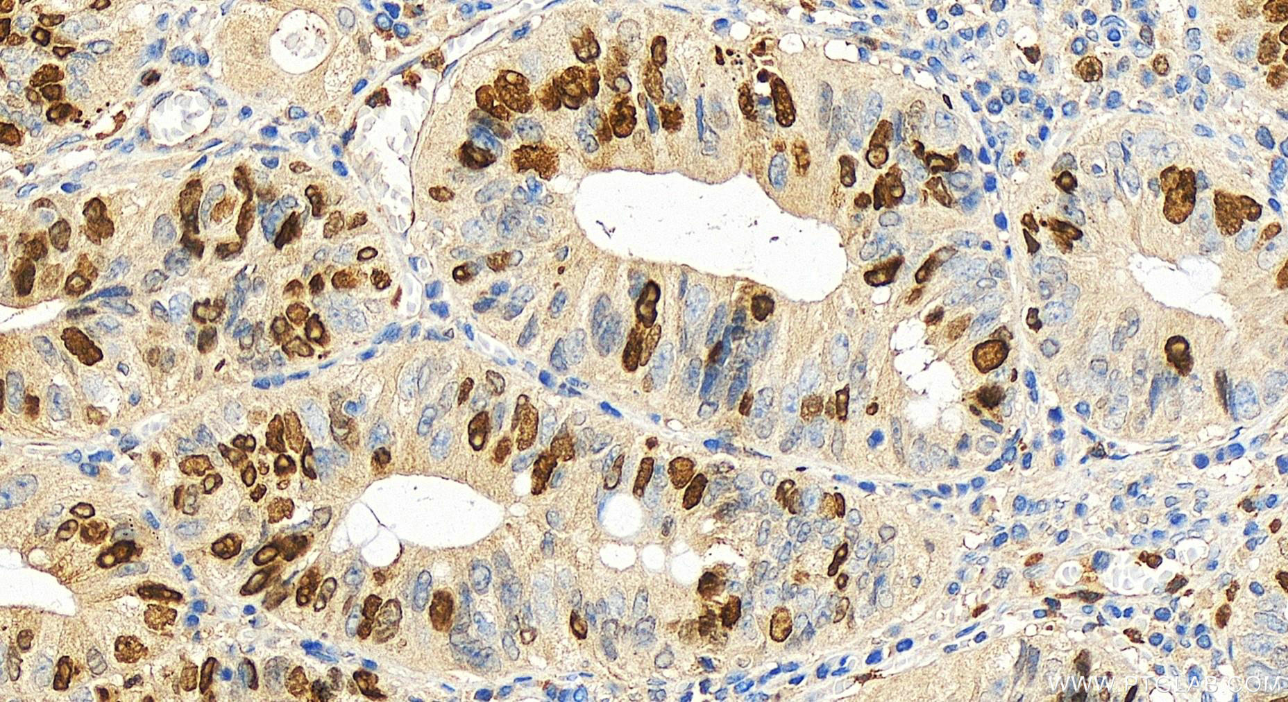 Immunohistochemistry (IHC) staining of human colon cancer tissue using TPX2 Polyclonal antibody (11741-1-AP)