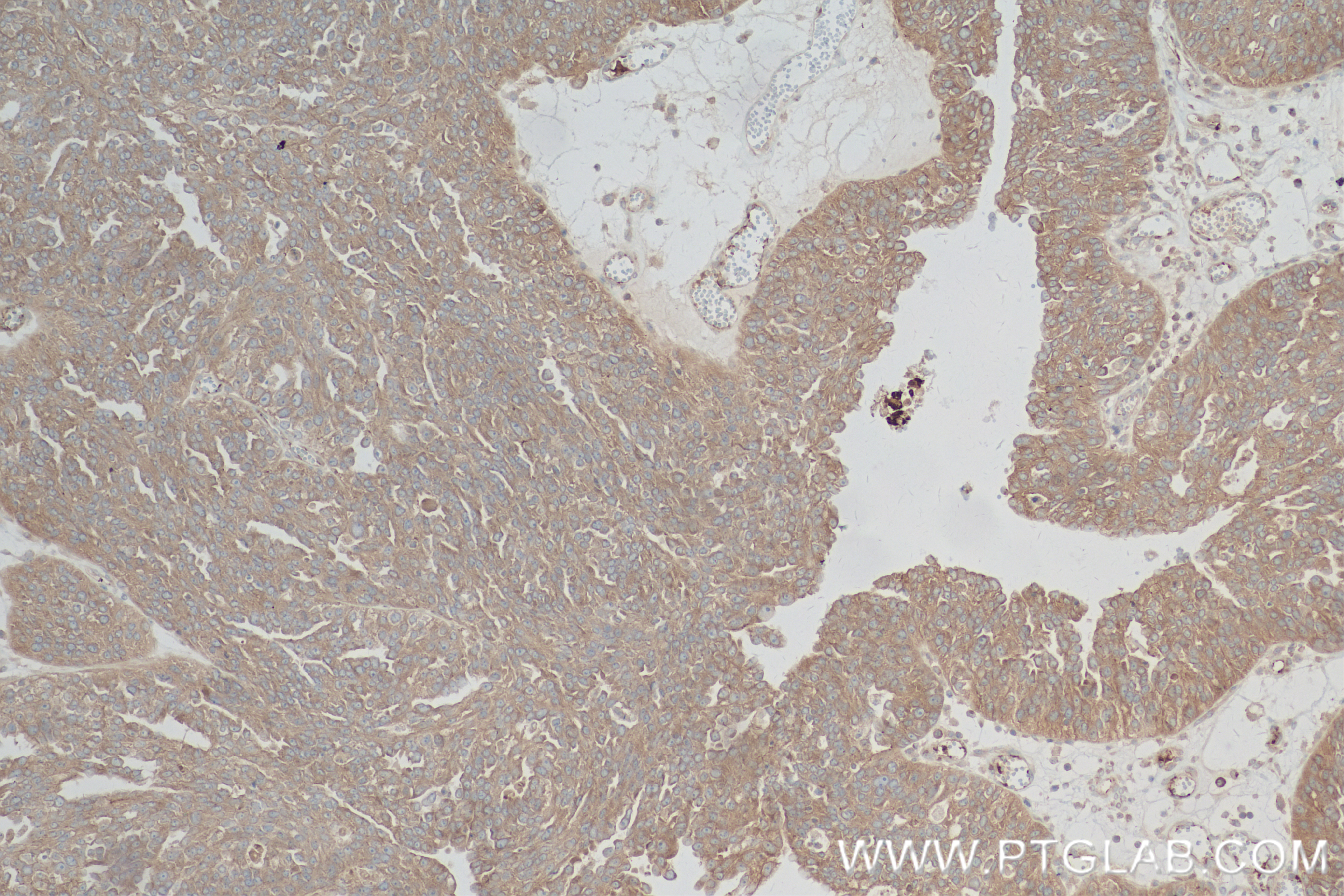 Immunohistochemistry (IHC) staining of human ovary cancer tissue using TRAF2 Recombinant antibody (84581-3-RR)