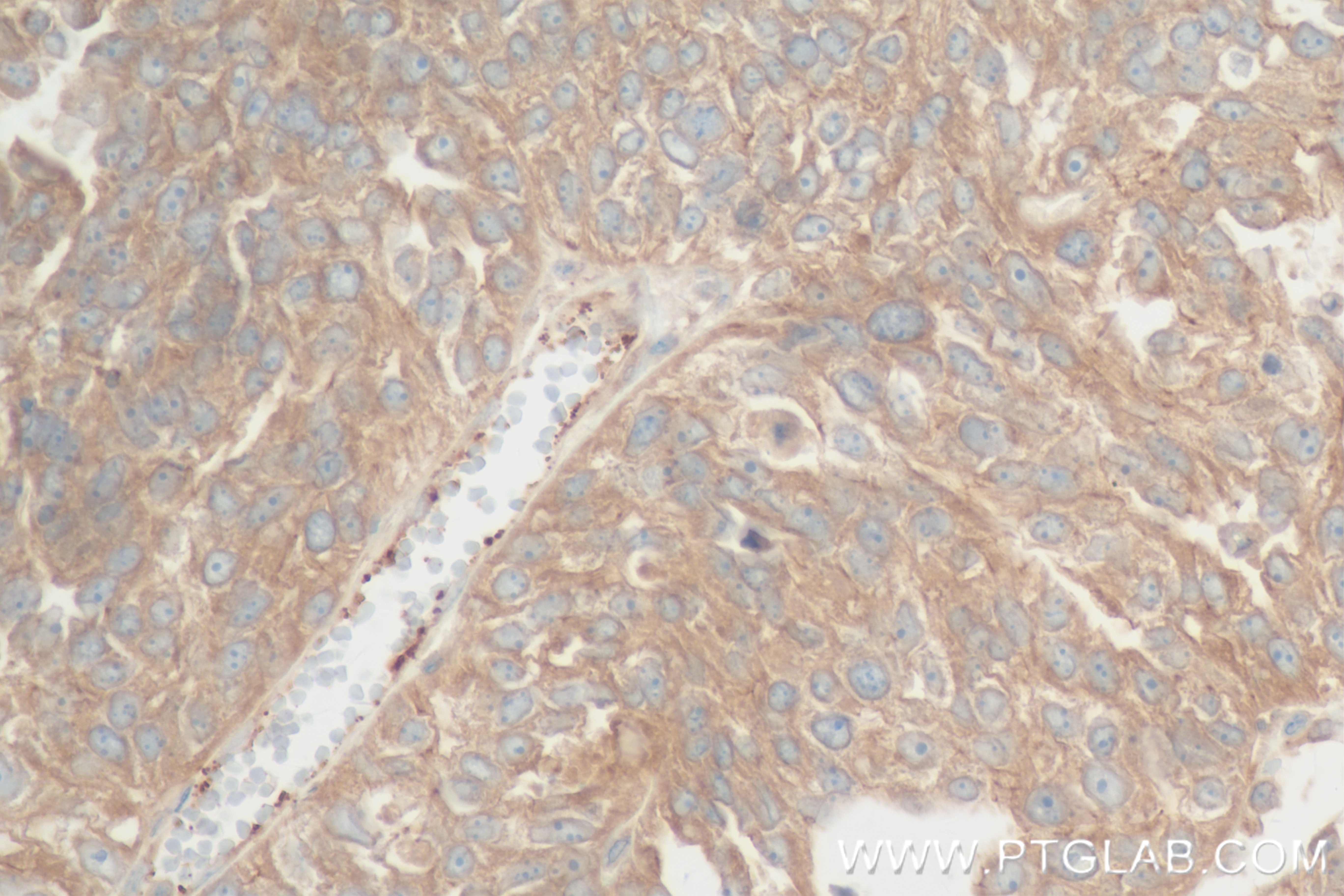 Immunohistochemistry (IHC) staining of human ovary cancer tissue using TRAF2 Recombinant antibody (84581-3-RR)