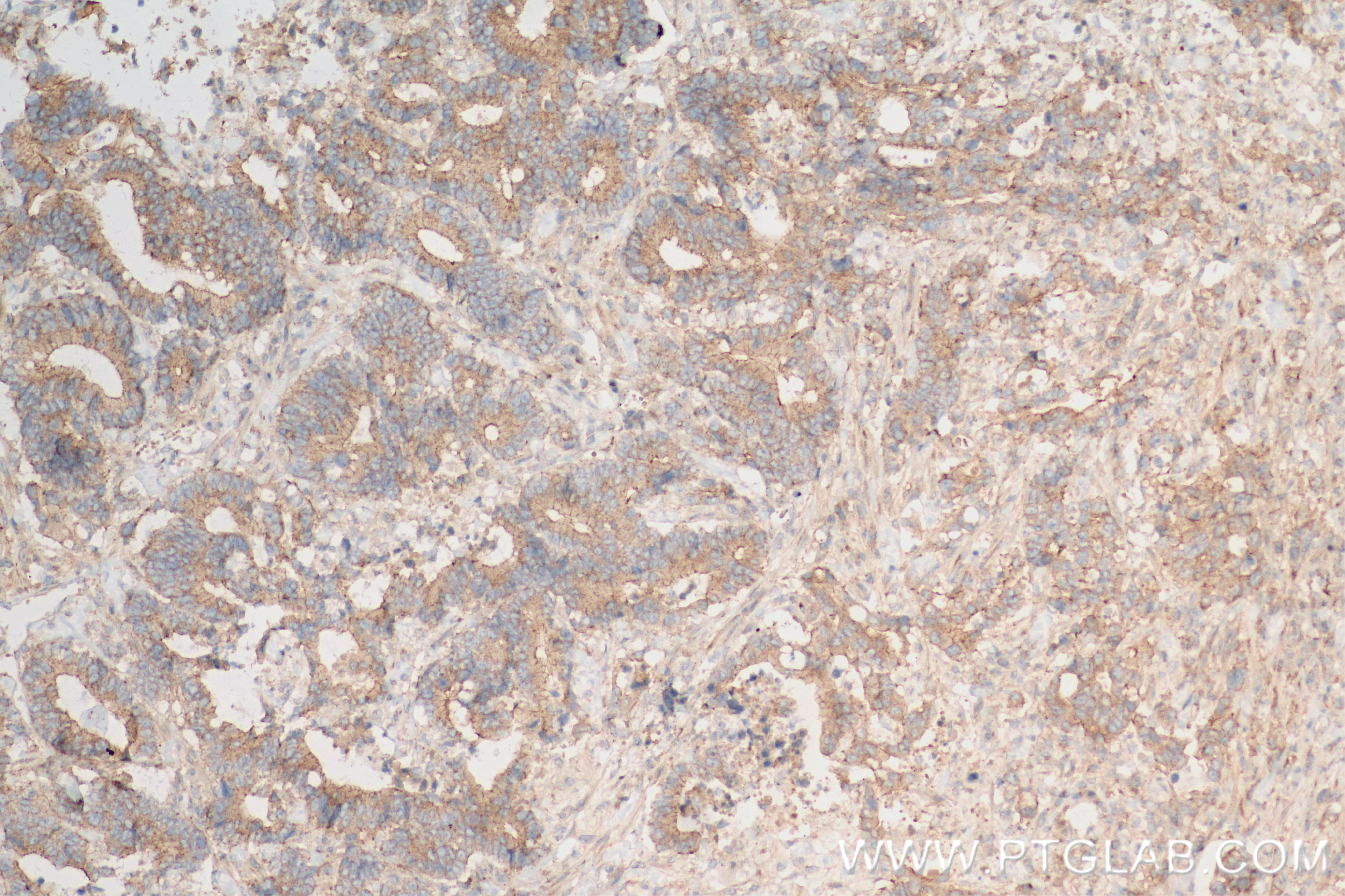 Immunohistochemistry (IHC) staining of human rectal cancer tissue using TRAF2 Recombinant antibody (84581-3-RR)