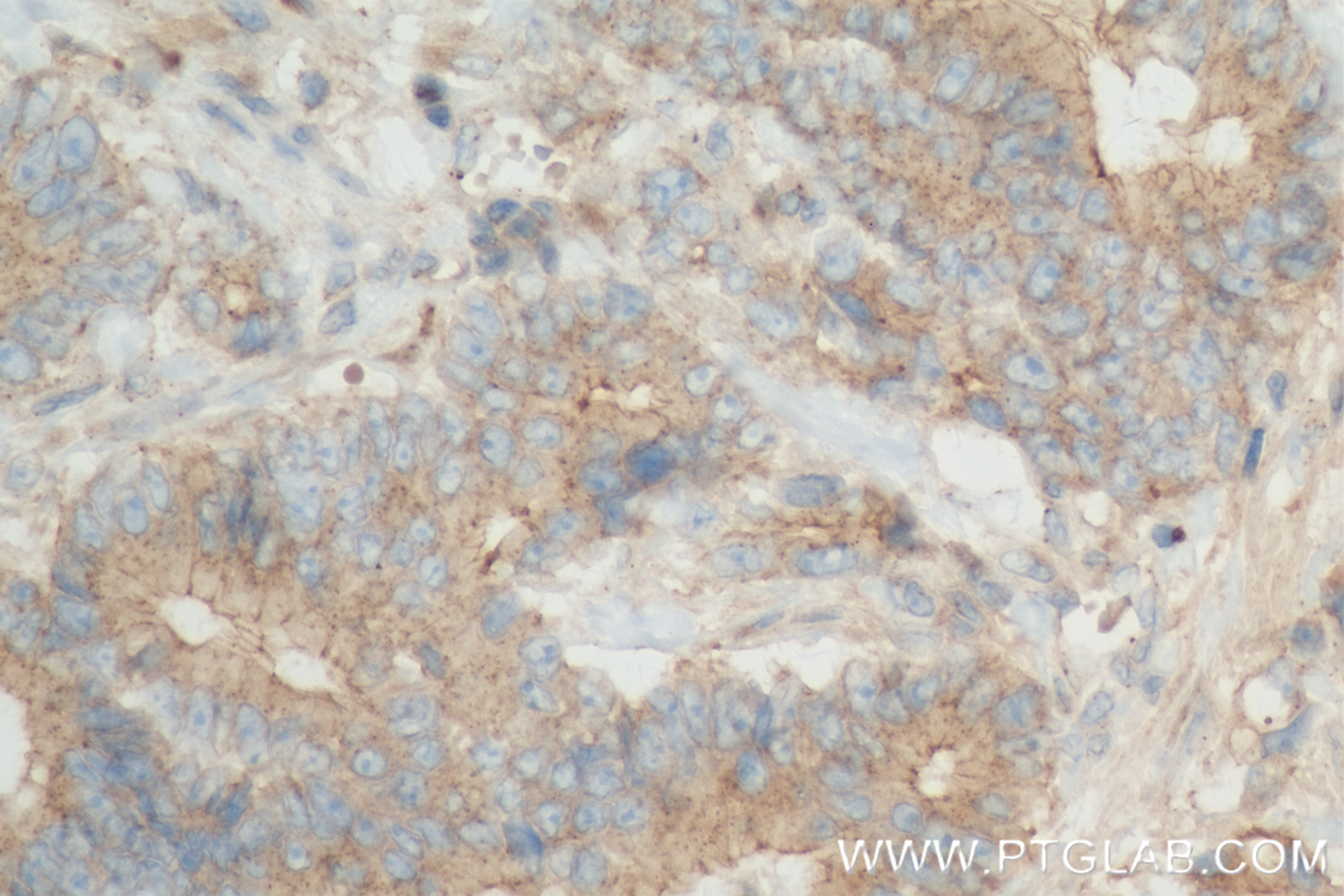 Immunohistochemistry (IHC) staining of human rectal cancer tissue using TRAF2 Recombinant antibody (84581-3-RR)