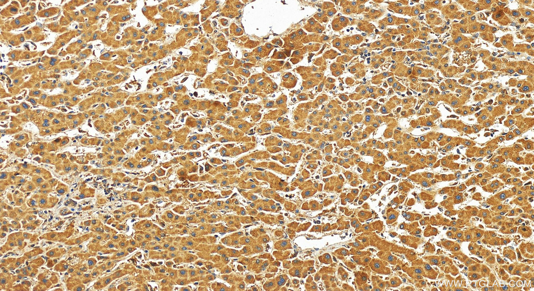 Immunohistochemistry (IHC) staining of human intrahepatic cholangiocarcinoma tissue using TRAFD1 Polyclonal antibody (27741-1-AP)