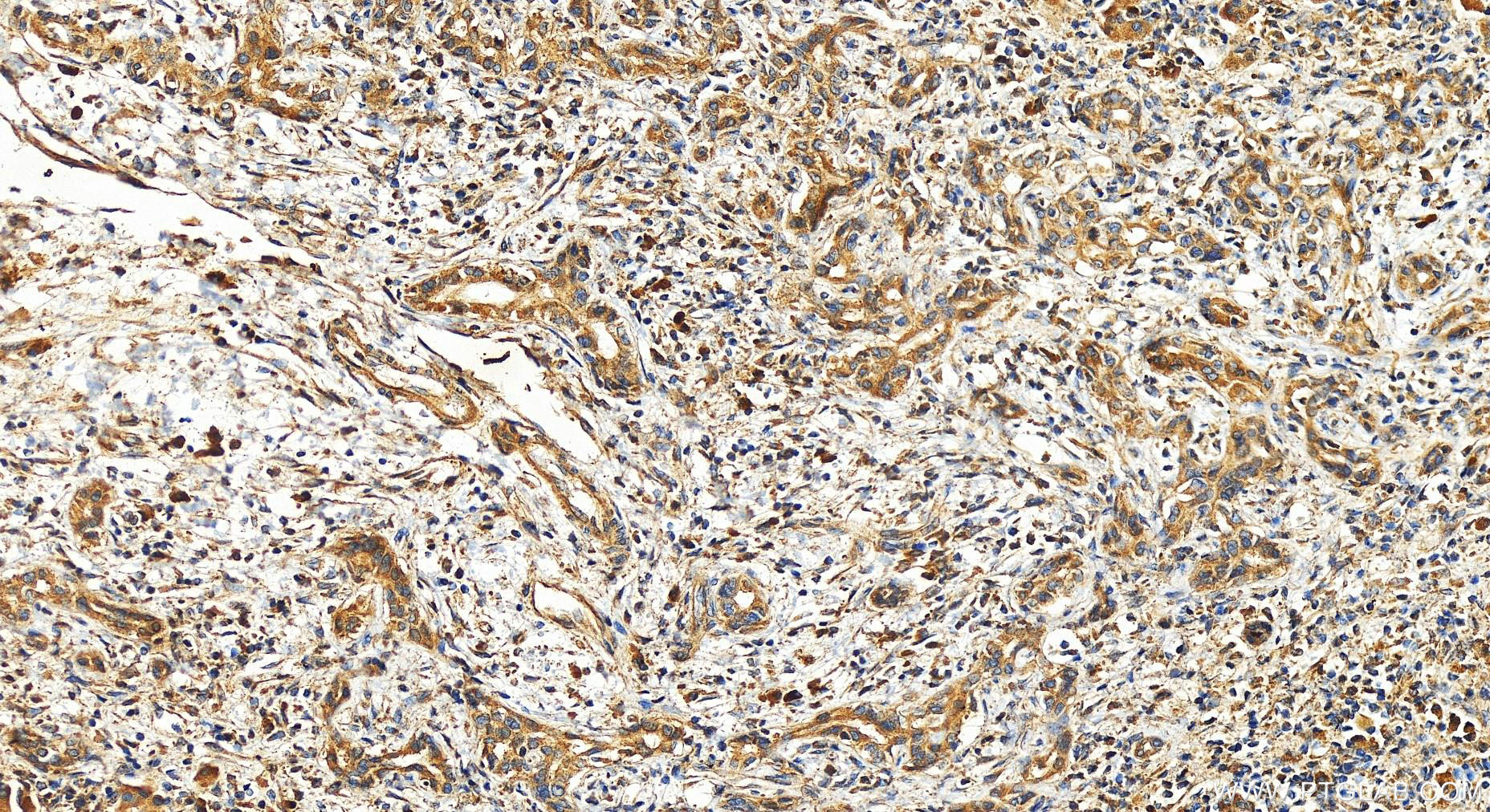 Immunohistochemistry (IHC) staining of human intrahepatic cholangiocarcinoma tissue using TRAFD1 Polyclonal antibody (27741-1-AP)