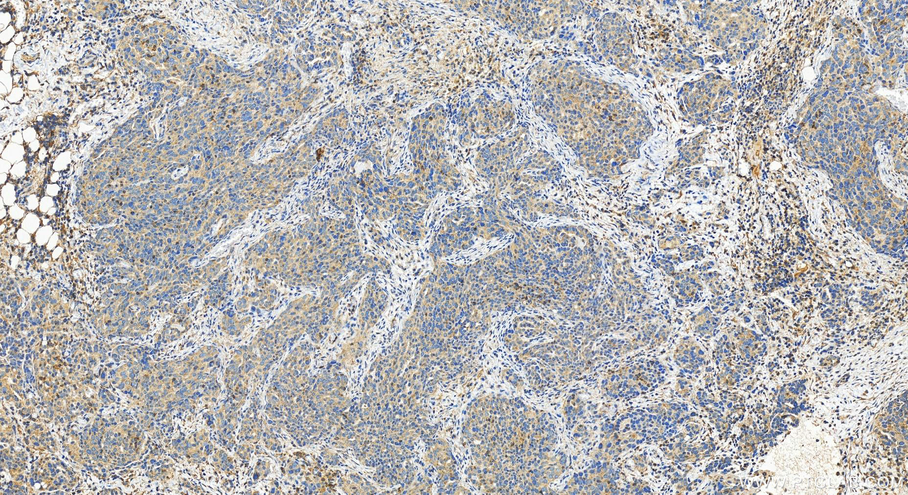 Immunohistochemistry (IHC) staining of human ovary cancer tissue using TRAFD1 Polyclonal antibody (27741-1-AP)