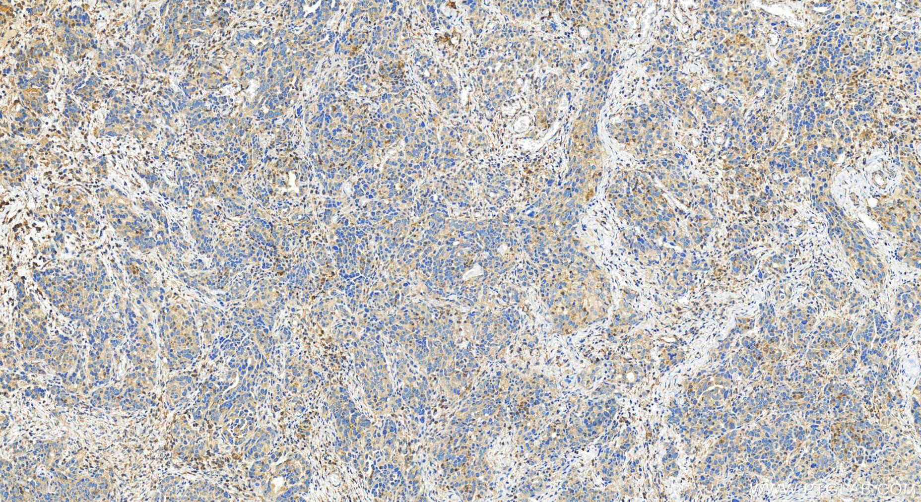 Immunohistochemistry (IHC) staining of human ovary cancer tissue using TRAFD1 Polyclonal antibody (27741-1-AP)