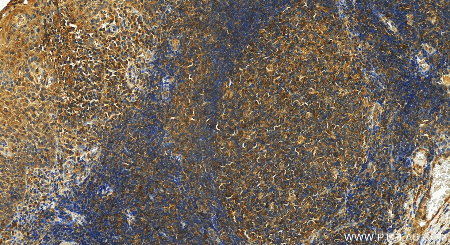 Immunohistochemistry (IHC) staining of human tonsillitis tissue using TRAFD1 Polyclonal antibody (27741-1-AP)