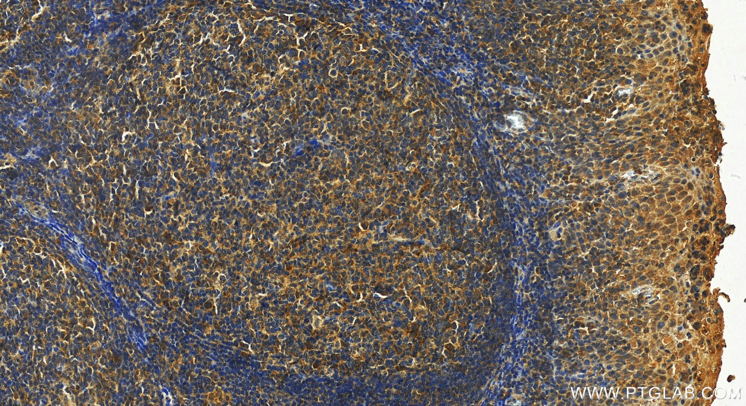 Immunohistochemistry (IHC) staining of human tonsillitis tissue using TRAFD1 Polyclonal antibody (27741-1-AP)