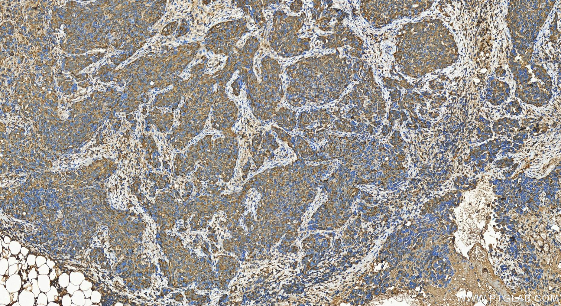 Immunohistochemistry (IHC) staining of human ovary cancer tissue using TRANK1 Polyclonal antibody (27583-1-AP)