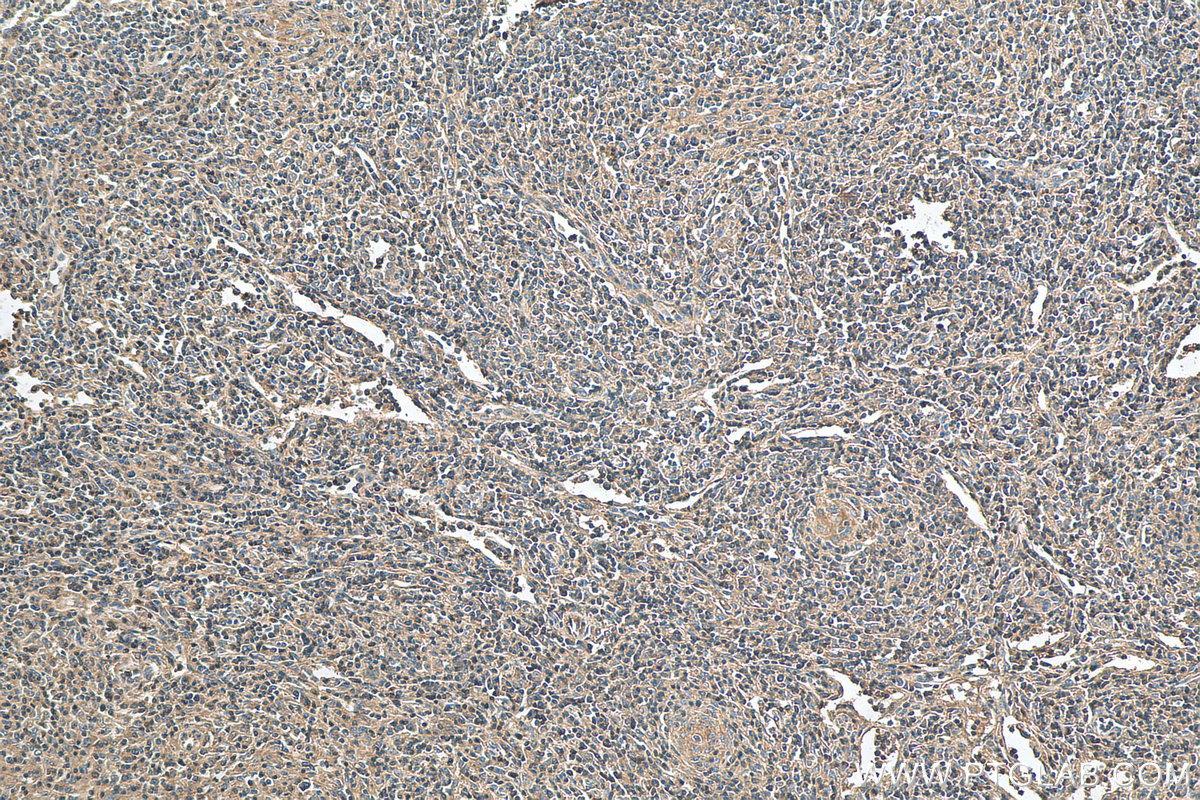 Immunohistochemistry (IHC) staining of human lymphoma tissue using TRAV20 Polyclonal antibody (13132-1-AP)