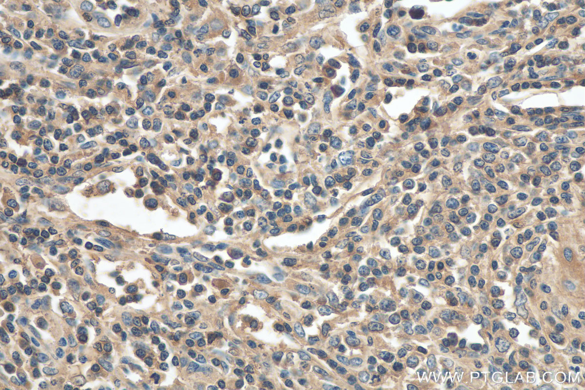 Immunohistochemistry (IHC) staining of human lymphoma tissue using TRAV20 Polyclonal antibody (13132-1-AP)