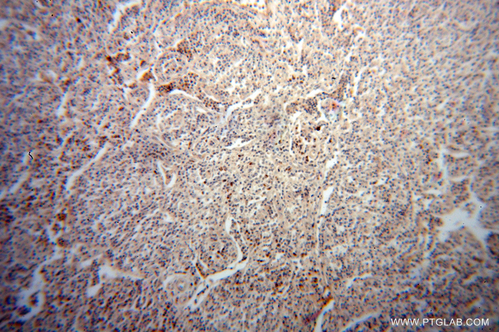 Immunohistochemistry (IHC) staining of human lymphoma tissue using TRAV20 Polyclonal antibody (13132-1-AP)