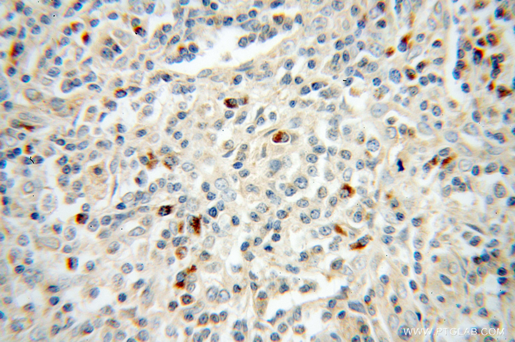 Immunohistochemistry (IHC) staining of human lymphoma tissue using TRAV20 Polyclonal antibody (13132-1-AP)