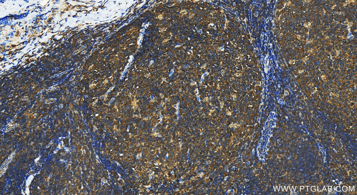 Immunohistochemistry (IHC) staining of human tonsillitis tissue using TREM1 Polyclonal antibody (11791-1-AP)