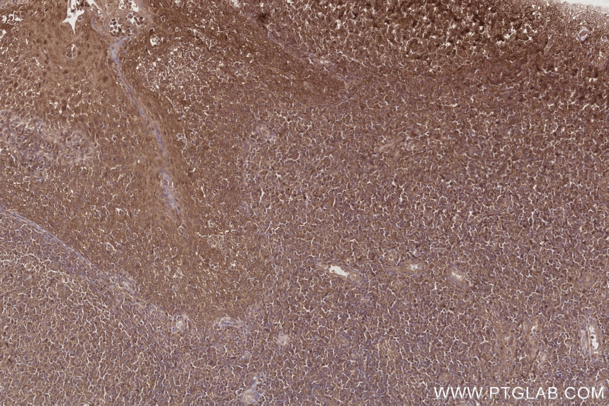 Immunohistochemistry (IHC) staining of human tonsillitis tissue using TRIM11 Polyclonal antibody (10851-1-AP)