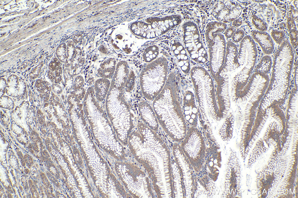 Immunohistochemistry (IHC) staining of human stomach cancer tissue using TRIM15 Polyclonal antibody (13623-1-AP)
