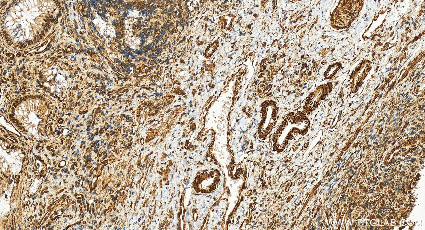 Immunohistochemistry (IHC) staining of human colon cancer tissue using TRIM21 Recombinant antibody (83530-3-RR)