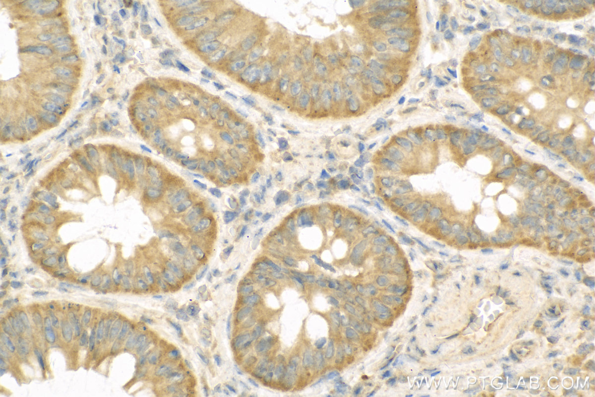 Immunohistochemistry (IHC) staining of Human Colon cancer tissue using TRIM31 Polyclonal antibody (12543-1-AP)