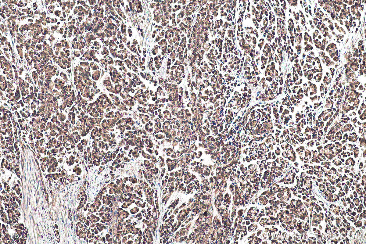 Immunohistochemistry (IHC) staining of human colon cancer tissue using TRIM47 Polyclonal antibody (26885-1-AP)