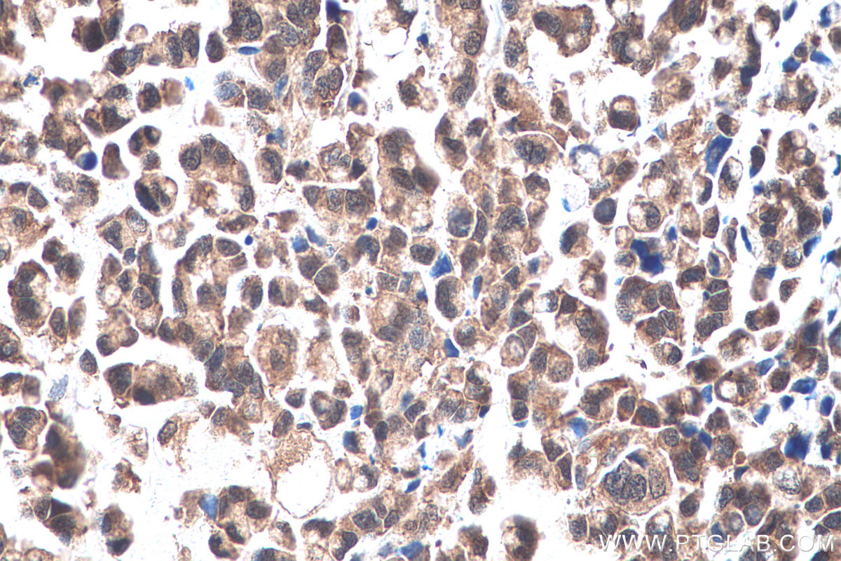 Immunohistochemistry (IHC) staining of human colon cancer tissue using TRIM47 Polyclonal antibody (26885-1-AP)