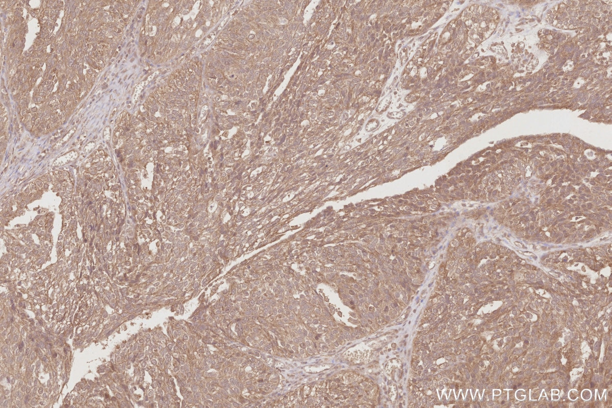 Immunohistochemistry (IHC) staining of human ovary cancer tissue using TRIM5 Monoclonal antibody (67492-1-Ig)