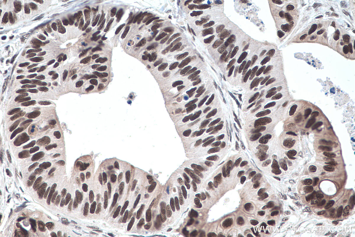 Immunohistochemistry (IHC) staining of human colon cancer tissue using TRMT6 Polyclonal antibody (16727-1-AP)