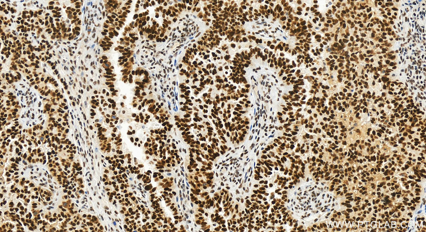 Immunohistochemistry (IHC) staining of human ovarian  cancer using TRMT6 Recombinant antibody (83843-5-RR)