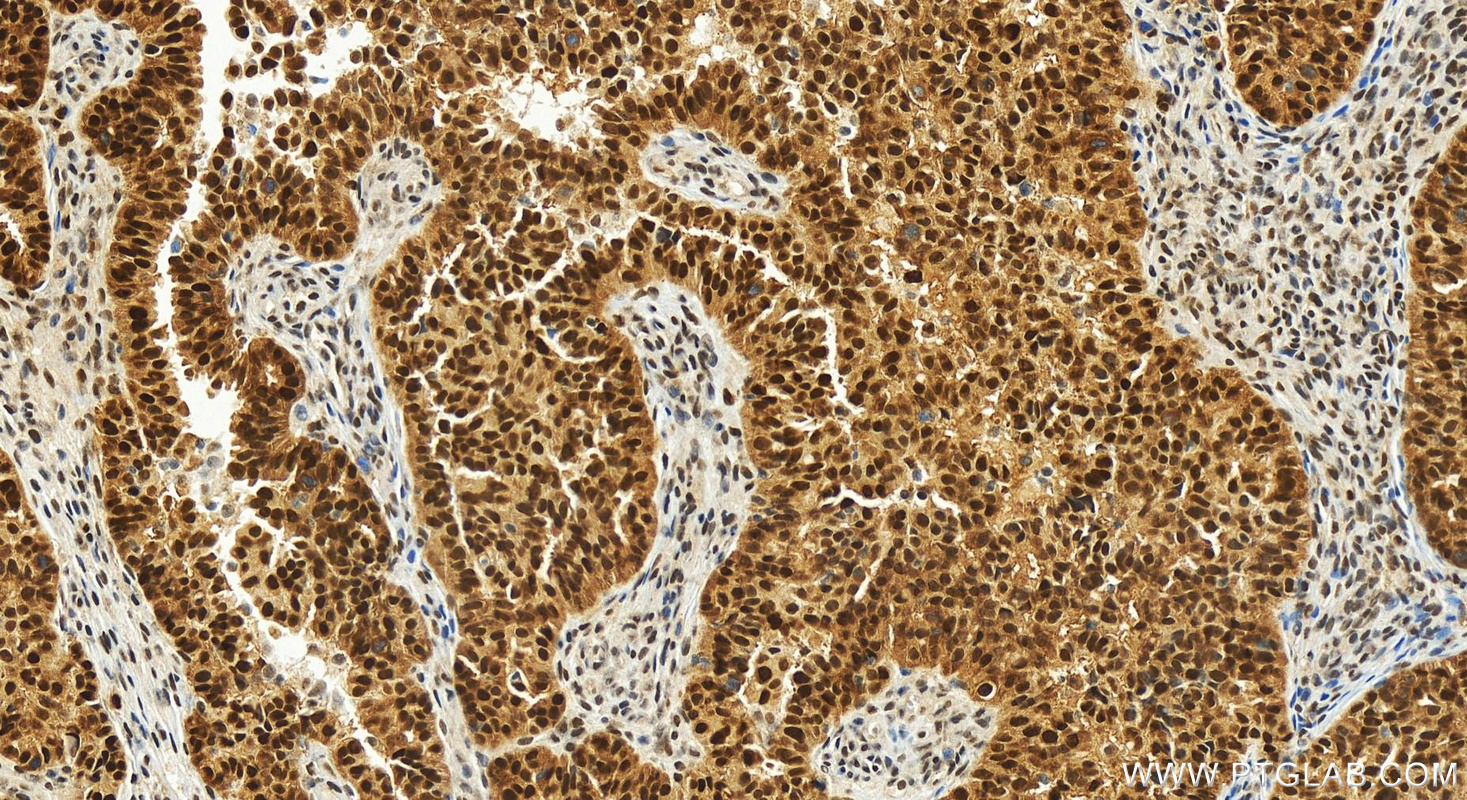 Immunohistochemistry (IHC) staining of human ovarian  cancer using TRMT6 Recombinant antibody (83843-6-RR)