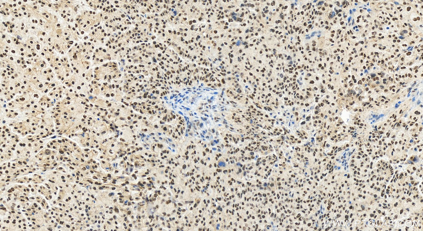 Immunohistochemistry (IHC) staining of human ovary cancer tissue using TRPS1 Polyclonal antibody (28753-1-AP)