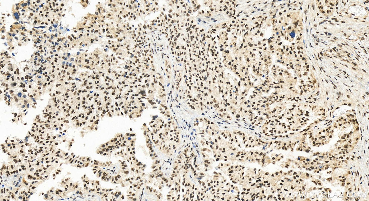 Immunohistochemistry (IHC) staining of human ovary cancer tissue using TRPS1 Polyclonal antibody (28753-1-AP)