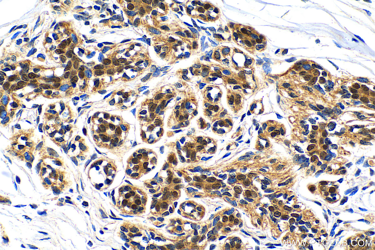 Immunohistochemistry (IHC) staining of human breast cancer tissue using TRPS1 Recombinant antibody (83062-4-RR)