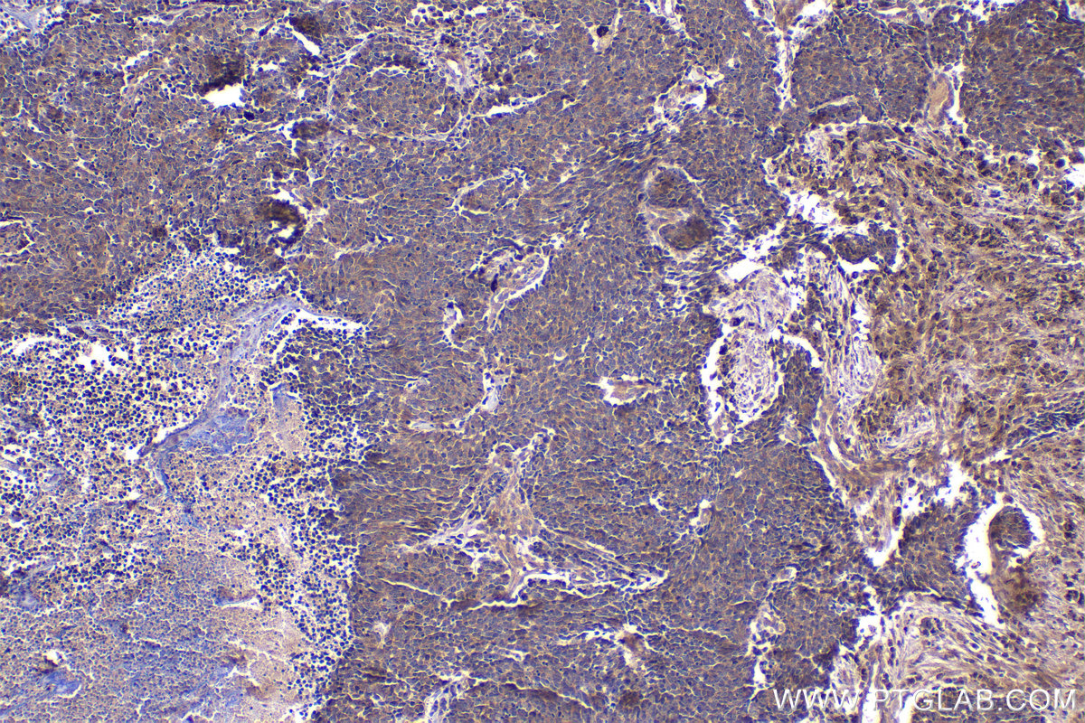 Immunohistochemistry (IHC) staining of human lung cancer tissue using Tuberin/TSC2 Monoclonal antibody (68380-1-Ig)