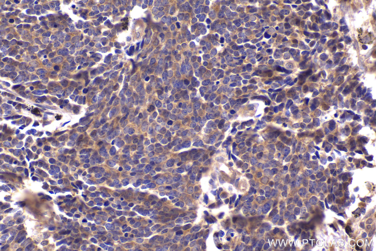 Immunohistochemistry (IHC) staining of human lung cancer tissue using Tuberin/TSC2 Monoclonal antibody (68380-1-Ig)