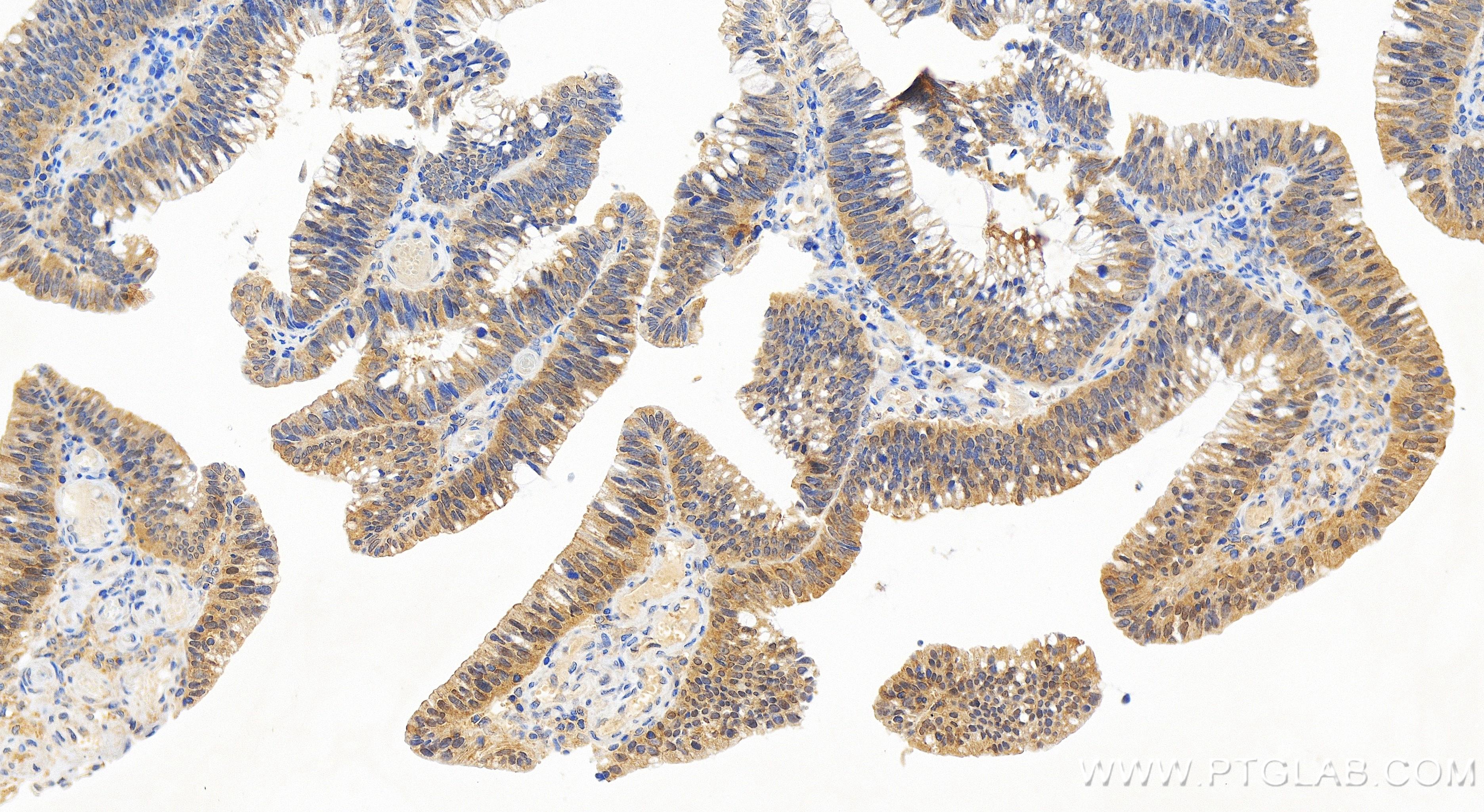 Immunohistochemistry (IHC) staining of human colon cancer tissue using TSG101 Recombinant antibody (84334-4-RR)