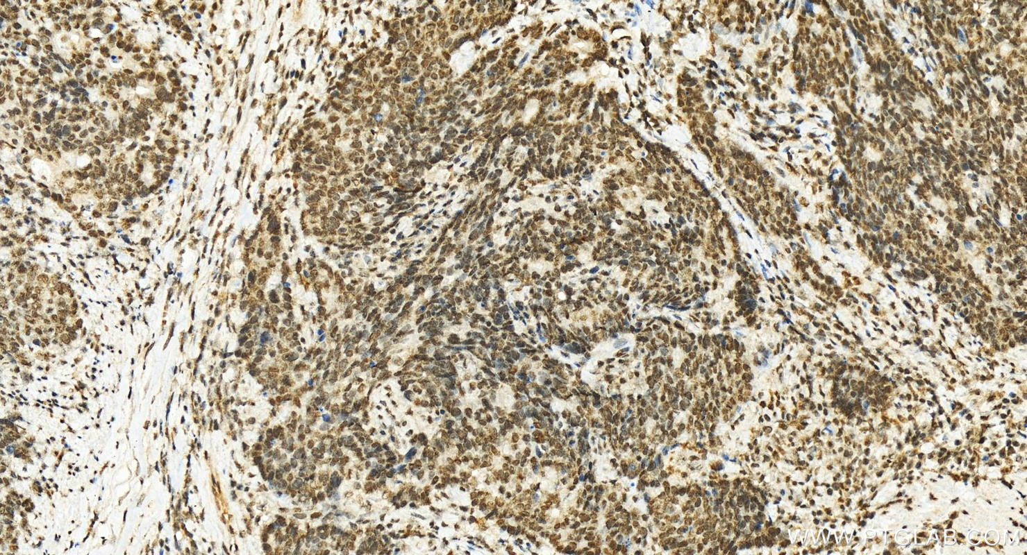 Immunohistochemistry (IHC) staining of human stomach cancer tissue using TSPAN5 Polyclonal antibody (12122-1-AP)