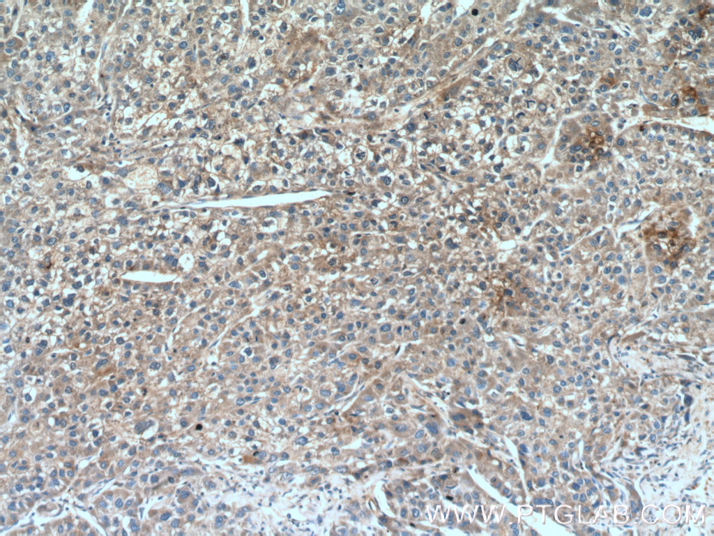 Immunohistochemistry (IHC) staining of human liver cancer tissue using TSSK3 Polyclonal antibody (12940-1-AP)