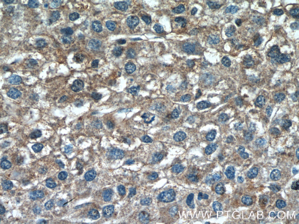 Immunohistochemistry (IHC) staining of human liver cancer tissue using TSSK3 Polyclonal antibody (12940-1-AP)