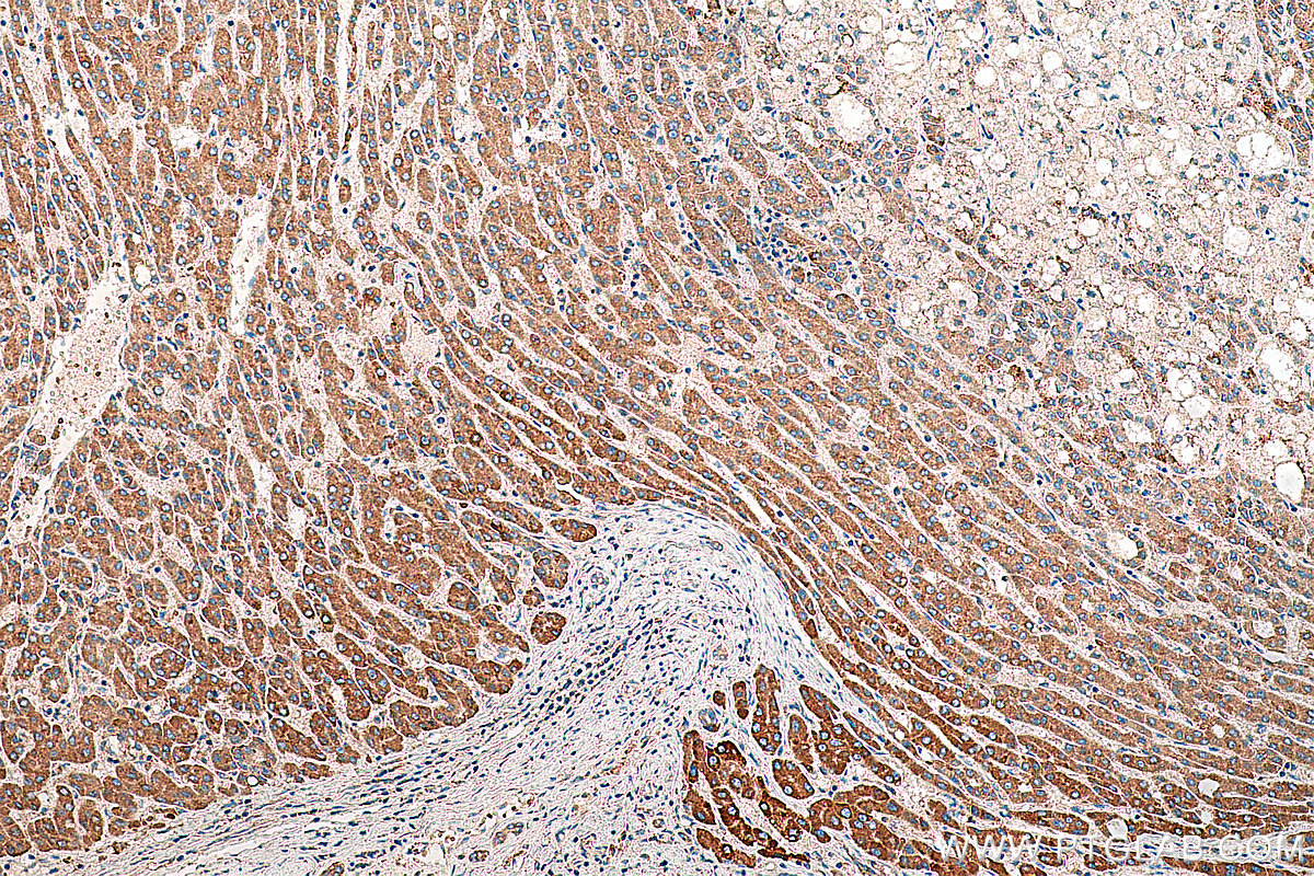 Immunohistochemistry (IHC) staining of human liver cancer tissue using TTC39B Polyclonal antibody (23432-1-AP)