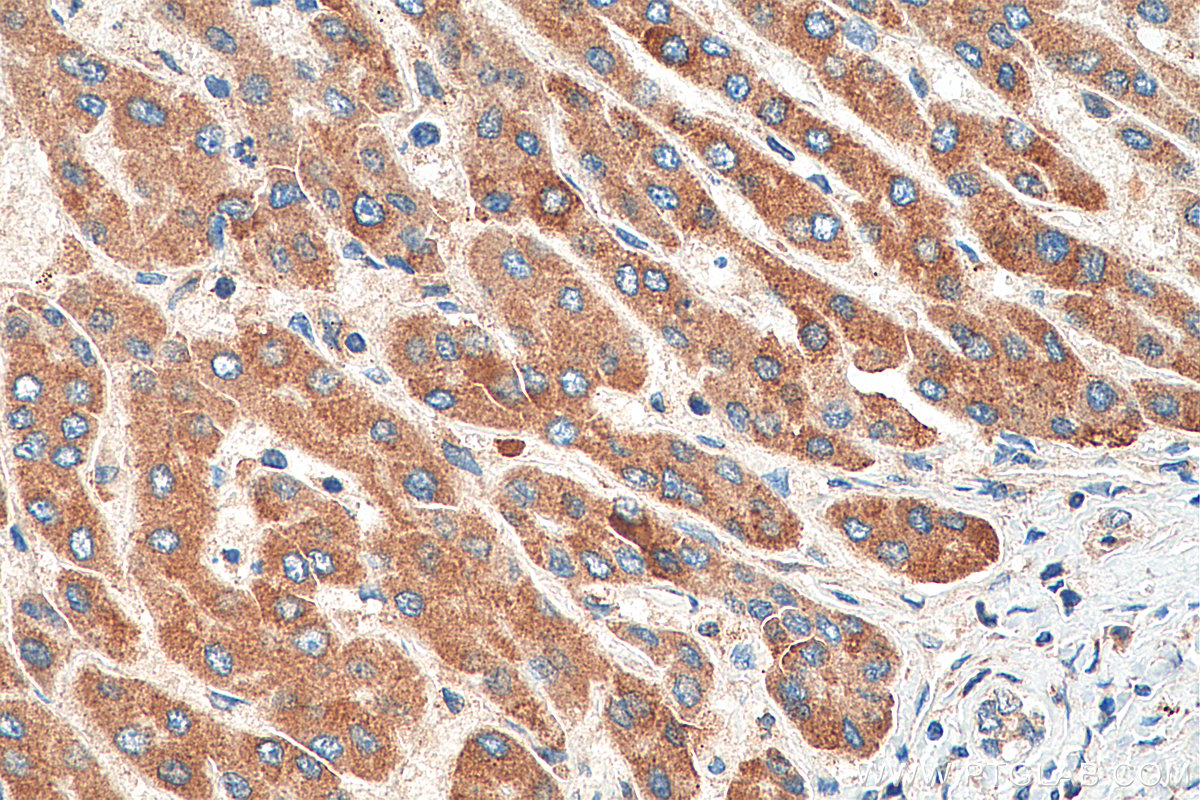 Immunohistochemistry (IHC) staining of human liver cancer tissue using TTC39B Polyclonal antibody (23432-1-AP)