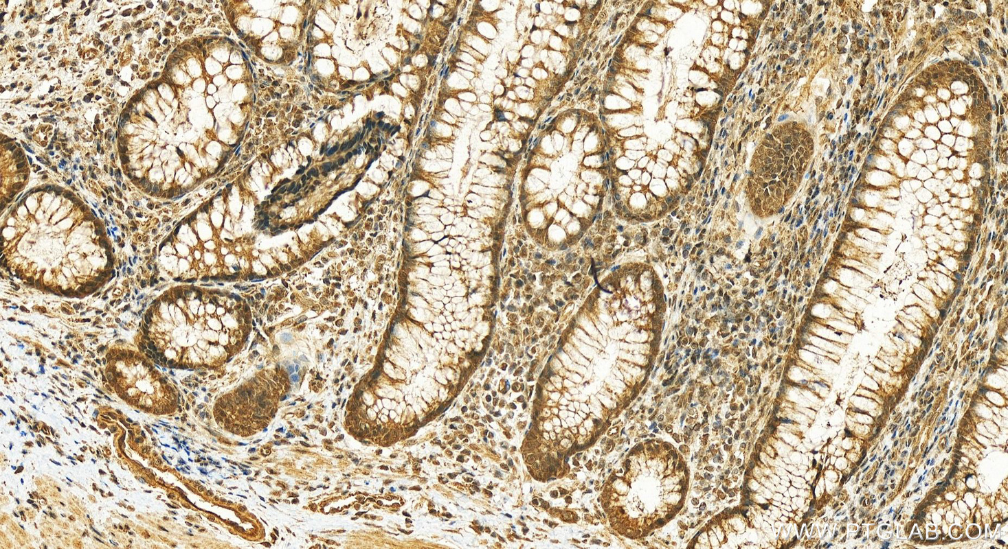 Immunohistochemistry (IHC) staining of human colon cancer tissue using TTC5 Polyclonal antibody (26112-1-AP)