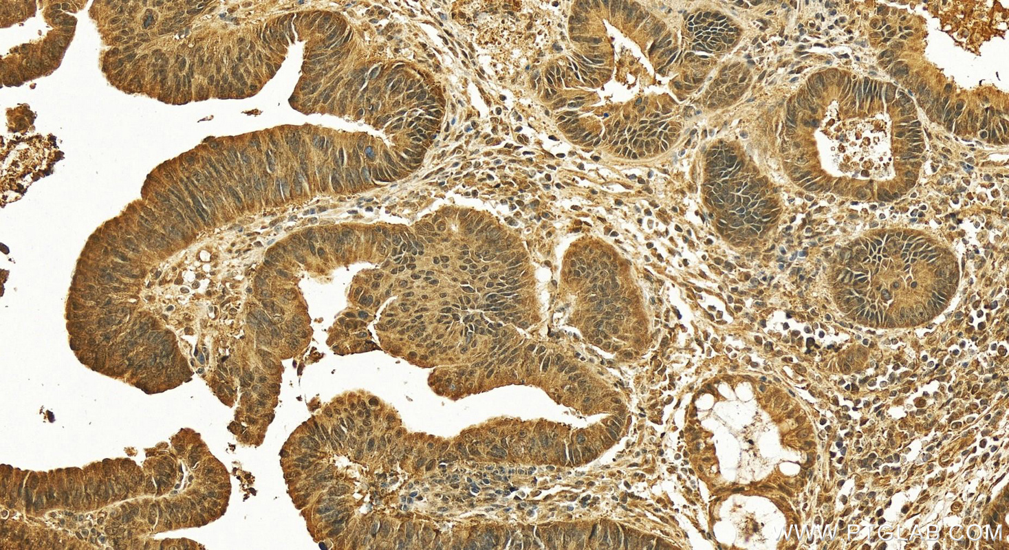 Immunohistochemistry (IHC) staining of human colon cancer tissue using TTC5 Polyclonal antibody (26112-1-AP)