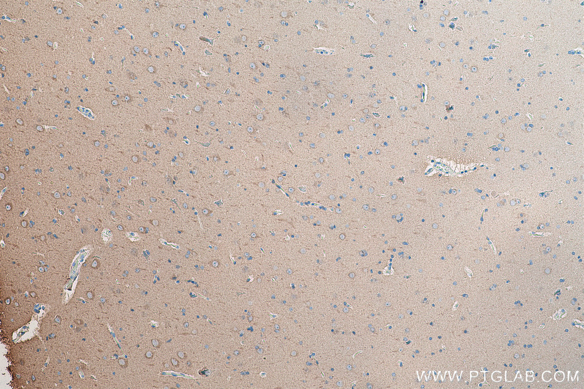 Immunohistochemistry (IHC) staining of human gliomas tissue using Beta Tubulin Polyclonal antibody (10063-2-AP)