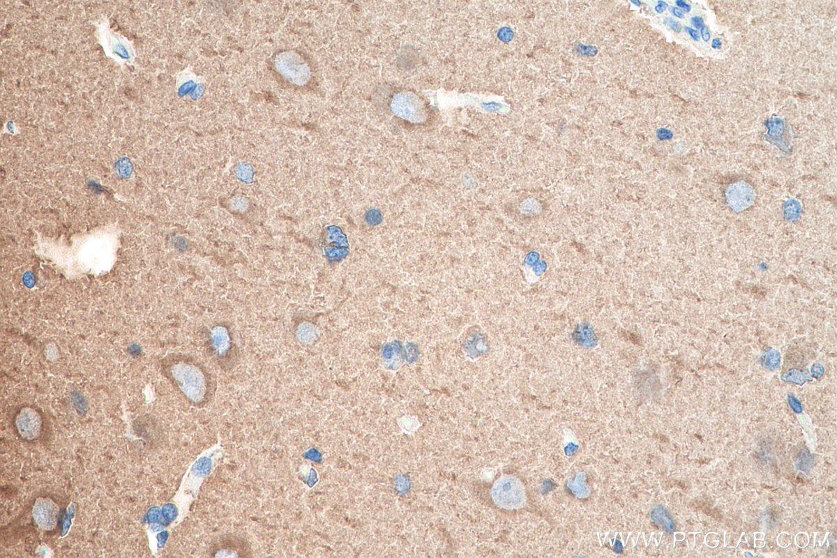 Immunohistochemistry (IHC) staining of human gliomas tissue using Beta Tubulin Polyclonal antibody (10063-2-AP)